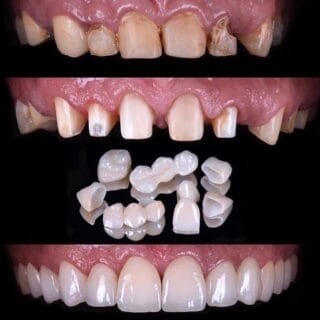 https://e85xhh4zzhf.exactdn.com/wp-content/uploads/2025/04/full-mouth-reconstruction-320x320.jpg?strip=all&lossy=1&ssl=1